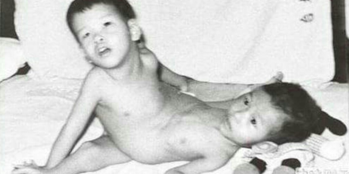 38 Tahun Setelah Operasi Pemisahan 2 Saudara Kembar Siam, Kini Cong Ren dan Cong Yi Hidup Normal