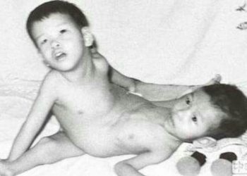 38 Tahun Setelah Operasi Pemisahan 2 Saudara Kembar Siam, Kini Cong Ren dan Cong Yi Hidup Normal