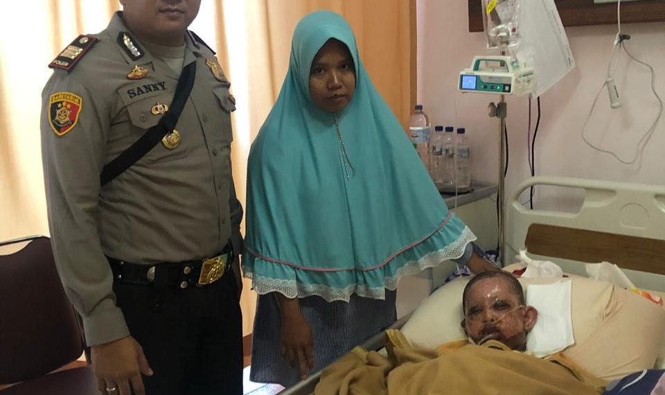 Akibat Bermain Mercon, Seorang Bocah di Tapung Alami Luka Bakar Serius